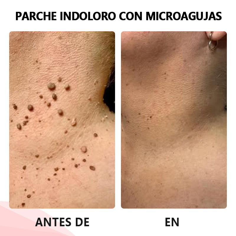 💥ODALIT™microparche avanzado sin dolor💥
