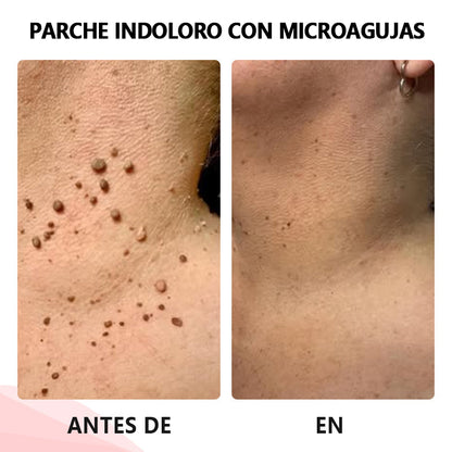 💥ODALIT™microparche avanzado sin dolor💥