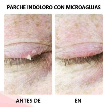 💥ODALIT™microparche avanzado sin dolor💥